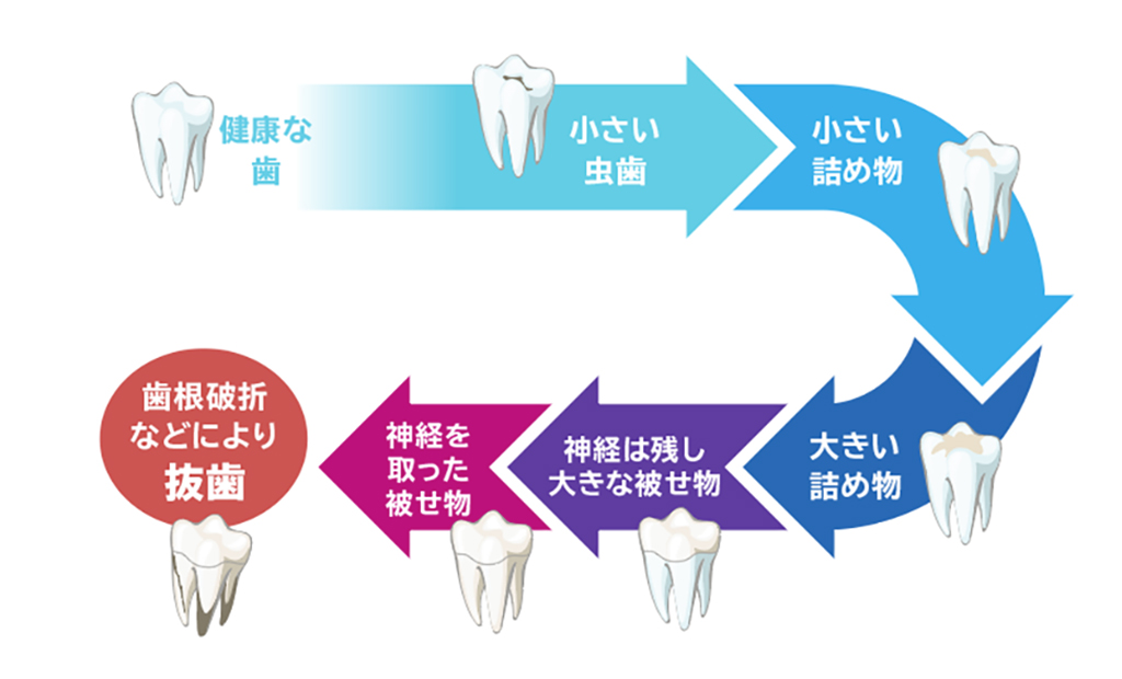 歯を失ってしまう原因の1つが「むし歯をくり返すこと」